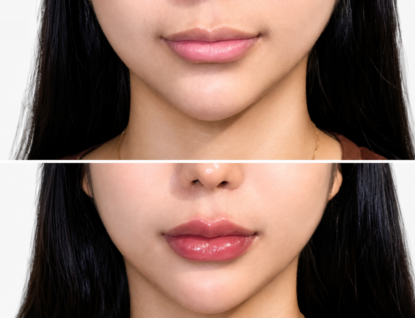 Injections & Fillers