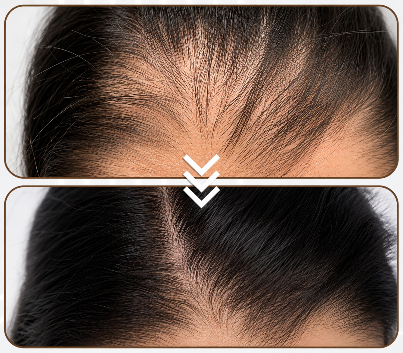 Hair Restoration